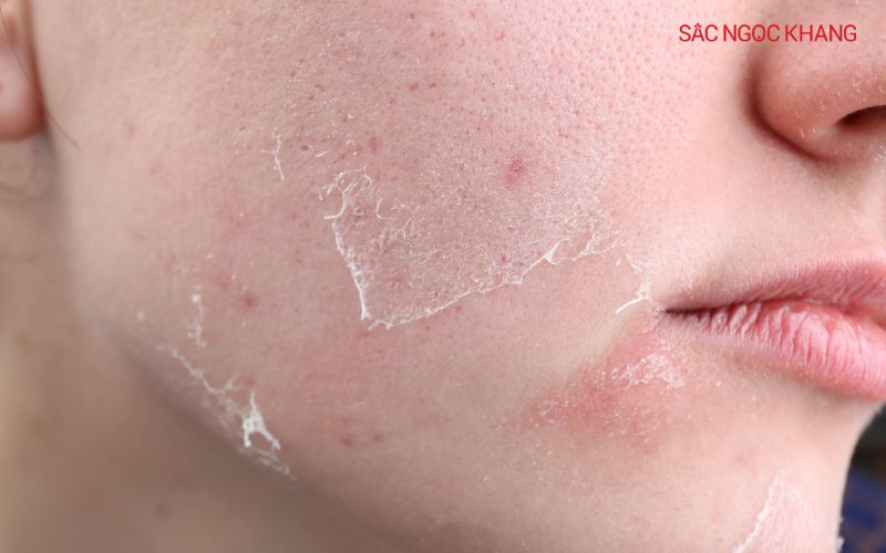 Da khô thường thiếu nước, gây ra tình trạng bong tróc, căng rát.