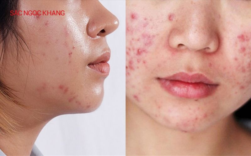 serum cho da dầu mụn