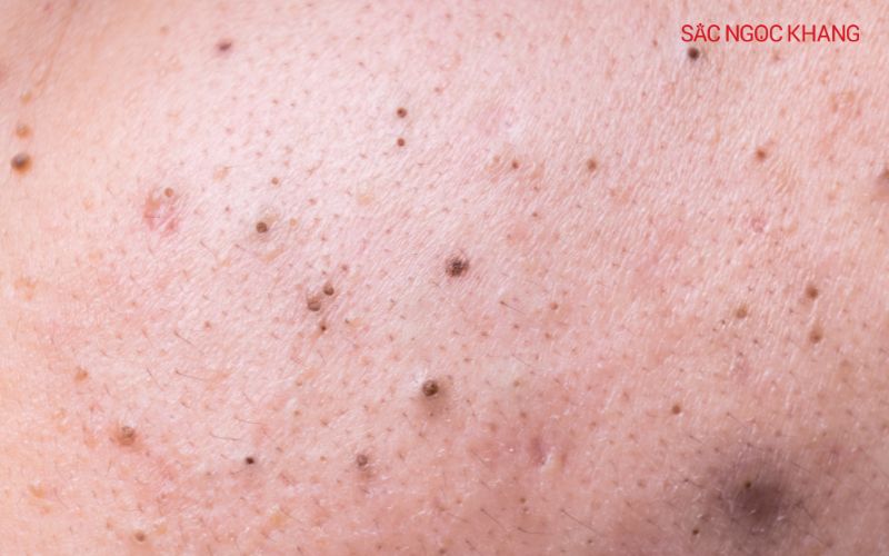 Mụn đầu đen hình thành do lỗ chân lông bị tắc nghẽn bởi bã nhờn và tế bào chết