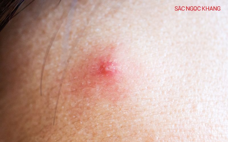 Mụn viêm bao gồm mụn mủ và mụn bọc