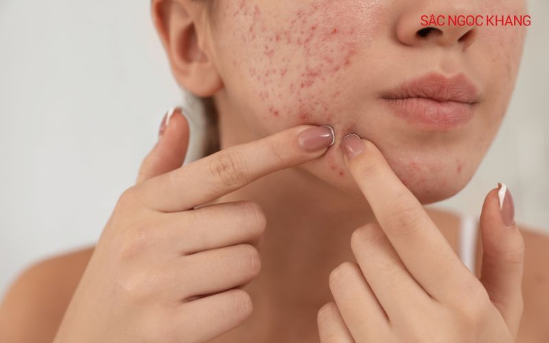 Việc nặn mụn có thể làm tình trạng mụn trở nên nghiêm trọng hơn