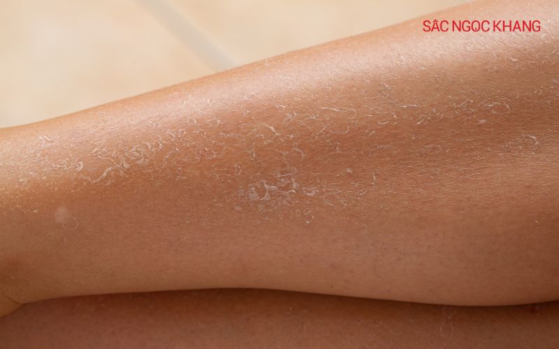 Có nhiều yếu tố góp phần gây nên tình trạng khô da