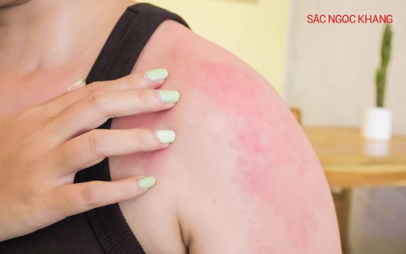 Da nhạy cảm có hàng rào bảo vệ da yếu