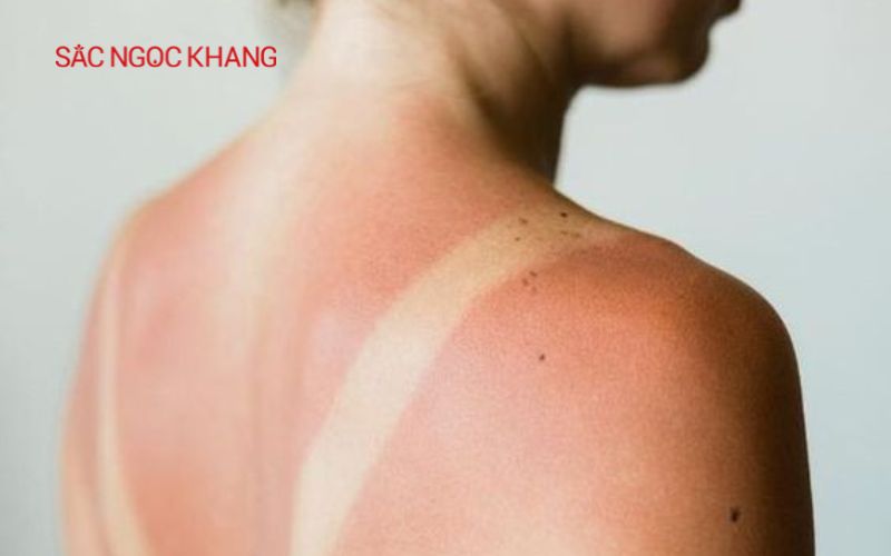 Tia cực tím gây cháy da