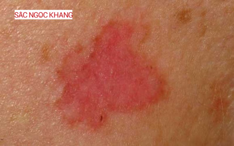tia cực tím gây ung thư da
