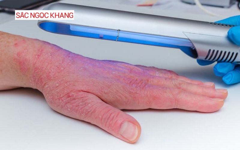 tia cực tím có khả năng điều trị bệnh vảy nến