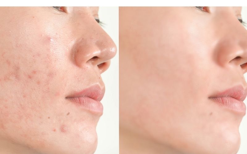 thâm mụn bao lâu thì hết