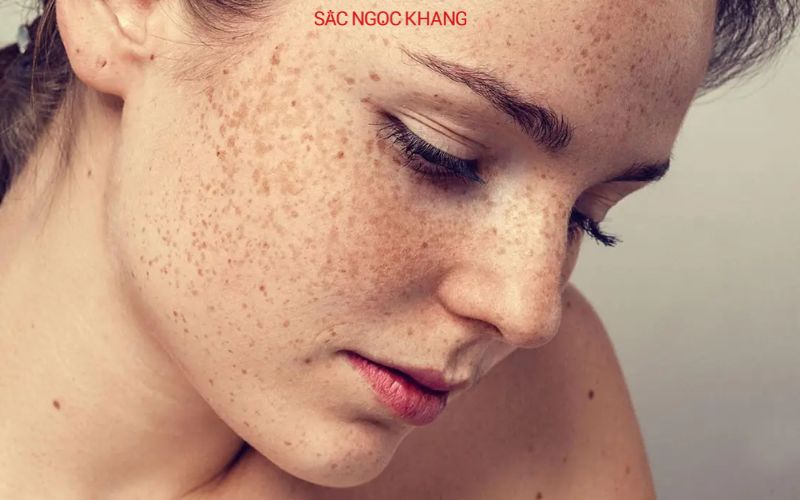 trị nám tàn nhang