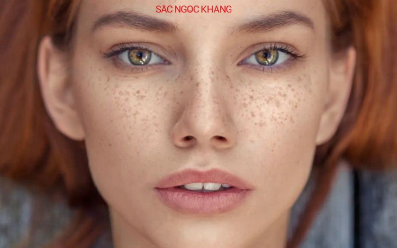 trị nám tàn nhang