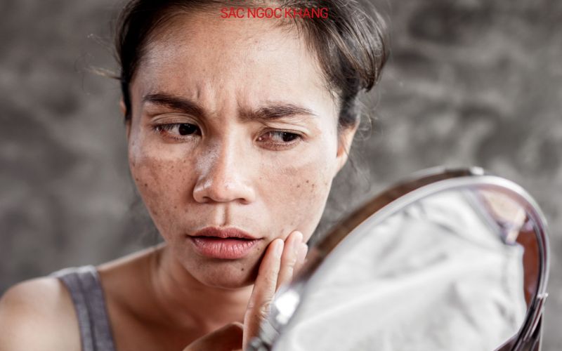 trị nám tàn nhang