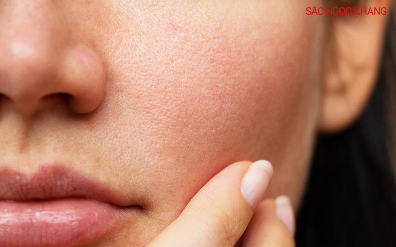 Nhiều loại kem chống nắng chứa thành phần gây bít tắc lỗ chân lông