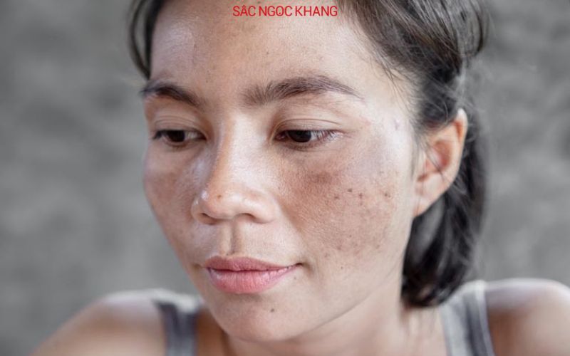 viên uống hỗ trợ trị nám