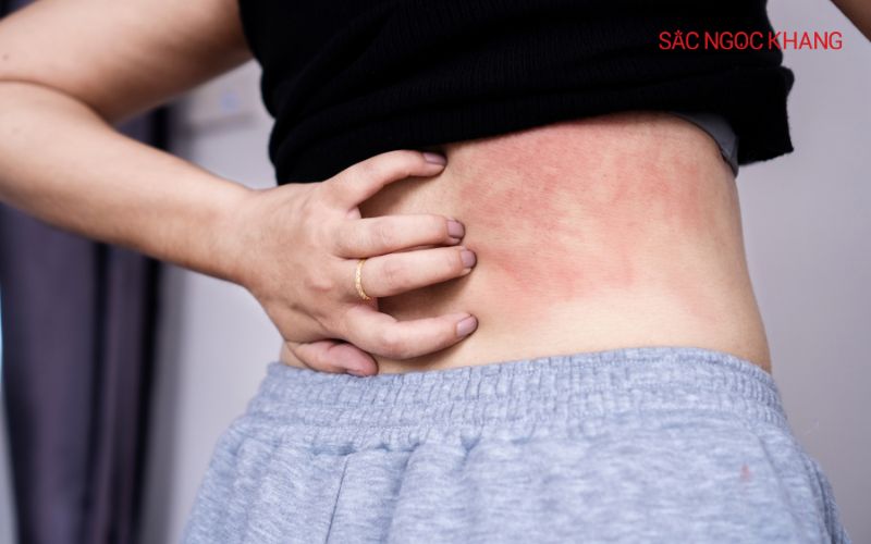 Các chất làm trắng da không rõ nguồn gốc có thể gây dị ứng, phát ban
