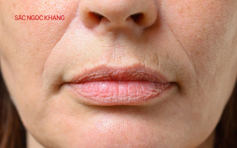 Nếp nhăn khóe miệng khiến khuôn mặt trở nên già nua